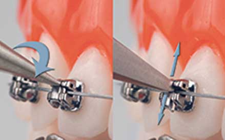 Damon Braces Elite Orthodontics Group in San Diego, CA