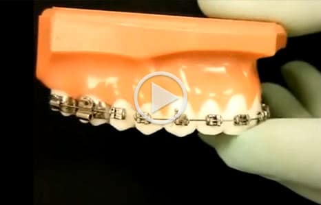 Emergency care video at Elite Orthodontics in San Diego, CA